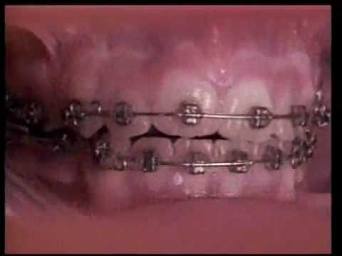 Was Brackets in 10 Monaten bewirken können (Zahnspange Timelapse)
